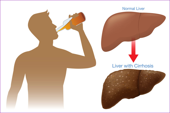 DETOXIFICACION HEPATICA